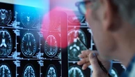 Il “falso” Alzheimer degli over 65, ecco quanto costa la malattia che si camuffa da demenza