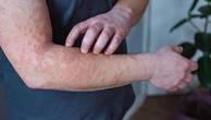 Lupus, al via il primo registro italiano: migliorerà la diagnosi (che arriva dopo anni)