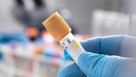 Hiv, la Prep a lunga durata anche in Italia: potrebbe migliorare l’aderenza alla terapia