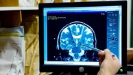 Hai avuto un Tia o mini-ictus? Ecco perché non dovresti sottovalutare le conseguenze