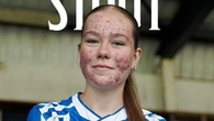 Scozia, giovane calciatrice insultata per l’acne: il Kilmarnock cancella il post dai social