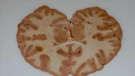 Il cervello degli uomini invecchia in modo diverso da quello delle donne
