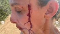 Sara Bluma, le foto delle violenze domestiche. “Troppo tempo in silenzio”. Can Yaman: “Sono con te”