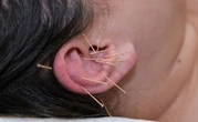 On a testé l’acupuncture (dans l’oreille) pour arrêter de fumer