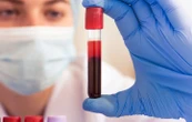 Un test sanguin pour détecter la bipolarité débarque en France