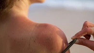 Canarias, en riesgo extremo por radiación ultravioleta durante el fin de semana