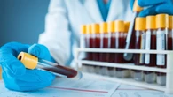 Estados Unidos aprueba el primer test de sangre que detecta el alzhéimer