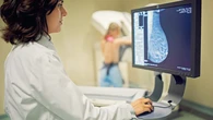 Estos son los síntomas del cáncer de mama lobulillar, el segundo más común