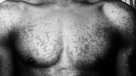¿Qué es la Pitiriasis versicolor? Así se manifiesta esta enfermedad que aparece cuando llega el verano