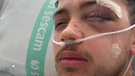 La brutal agresión a un árbitro de fútbol sala de 23 años: "Tuve que pasar por quirófano, me han puesto cinco placas en la cara"