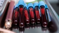 Esperanzador descubrimiento: identifican una nueva proteína en la sangre para detectar la enfermedad arterial coronaria