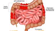 Así se manifiesta la enfermedad de Crohn: primeros síntomas a los que prestar atención