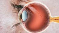 Qué son los nevus o lunares de ojos: los tres signos que deberías revisar, según asegura un oftalmólogo 