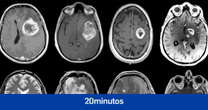 Investigan la curación del tumor cerebral más común y con peor pronóstico, el gliobastoma multiforme