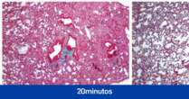 Investigadores españoles identifican una molécula que podría tratar los daños pulmonares causados por el covid