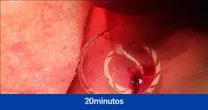 Hallan por primera vez en ratas de las alcantarillas de Valencia un parásito que causa meningitis