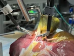 Un robot muestra que algún día las máquinas pueden sustituir a los cirujanos humanos
