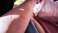 La ‘alergia’ al sol en verano: qué es realmente y cómo tratarla