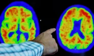 Un gigantesco mapa molecular abre el camino para curar el alzhéimer y el párkinson