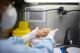 Europa rechaza el lecanemab, un controvertido fármaco contra el alzhéimer