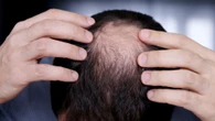 ¿Se te cae el pelo o sufres alopecia? Estos son los alimentos que puedes tomar para reducirlo