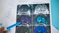Detecta a tiempo el cáncer de próstata: estas son las señales a las que debes prestar atención si tienes más de 50 años