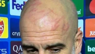 Las heridas en la cabeza de Guardiola tras su sexto tropiezo consecutivo: "Me quería hacer daño a mí mismo"