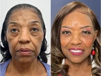 I paid $102,000 for a facelift at 71. I wish I could have done it a decade ago, but I couldn't afford it.