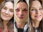 Against people's advice, I traveled to Mexico for a facelift. They assumed it was risky, but it turned out to be great.