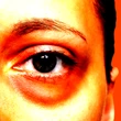 Would you spend $5,000 to remove your eye bags?