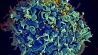 COVID-19 Derailed Fight Against AIDS, UN Says