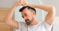 Hablemos de la 'calvicie masculina': causas, cómo tratarla y sentirte mejor