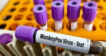 Secretario de Salud de Jalisco confirma primera muerte en 2025 por Mpox