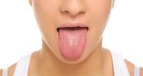 ¿Qué dice acerca de tu salud el color de tu lengua?