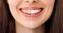 ¿Quieres dientes blancos? estos son los riesgos del blanqueamiento dental