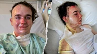 McDonald's worker allegedly doused with hot cooking oil by co-worker, suffers burns over 22% of his body