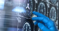 認知症の真犯人は「アミロイドβ」ではない？ 最新研究で浮上してきた「黒幕」の正体