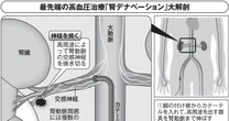高血圧に悩む人にとって「希望の光」全く新しい治療法・腎デナベーションをご存じですか