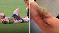 Gruesome image shows extent of Rabbitohs star’s sickening injury