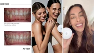 This dentist-directed teeth straightening treatment is HALF the price of Invisalign