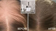 ‘Amazing’ hair loss product can grow 30,000 new strands in three months