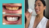 Teeth-whitening kit dentists love is slashed in price by up to 70 per cent: ‘My smile is brighter’