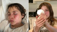 Dangerous viral trend leaves girl with severe burns after squishy toy explodes