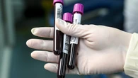Patients potentially exposed to blood-borne viruses at Sydney dentist