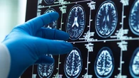 Almost half of dementia cases ‘preventable’ with new health guidelines