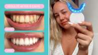 Game-changing teeth whitening kit dentists recommend is half price during end of year sale