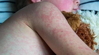 New measles alert as one case confirmed in Sydney