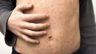 The major world capital experiencing kids’ measles outbreak