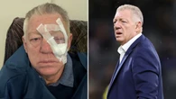 Phil Gould sporting ‘new eye’ after gruesome surgery