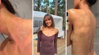 ‘It felt like my face was on fire’: The $24 pink cream selling every two minutes helping Aussies with eczema